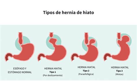 Todo Sobre Las Hernias De Hiato Causas Síntomas Y Tratamiento