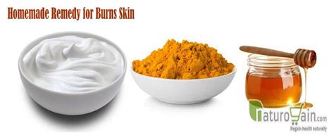 10 Best Home Remedies for Burns That Gives Fast Relief