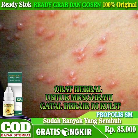 Jual Obat Gatal Berair Di Kulit Obat Gatal Alergi Pada Kulit Obat