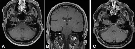 Preoperative MRI T1 CM A Axial B Coronal 6x4x3 Mm Measuring