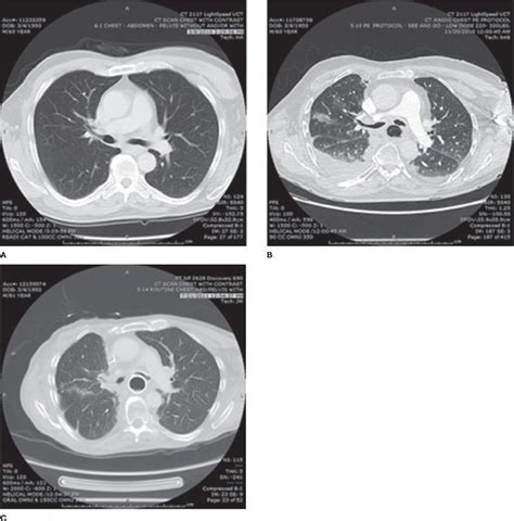 Radiation Pneumonitis | Thoracic Key