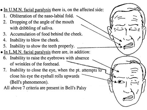 Facial Palsy Ppt