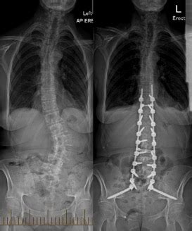 Scoliosis - Adult Degenerative Deformity - Sydney Neurospine