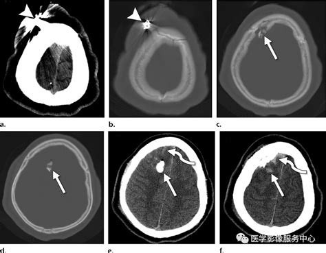 医影精品 创伤性颅脑损伤的影像学表现及并发症