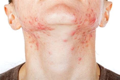 Hormonal Acne What It Is Causes Treatments And Remedies