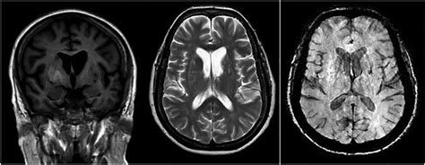 Hemichoreahemiballism A Case Report Practical Neurology