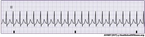 Vagal Maneuvers: How to Stop your Patient’s SVT | Health And Willness