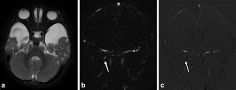 A 16 Month Old Male Axial T2 Weighted Image Showing Bilateral Type 2