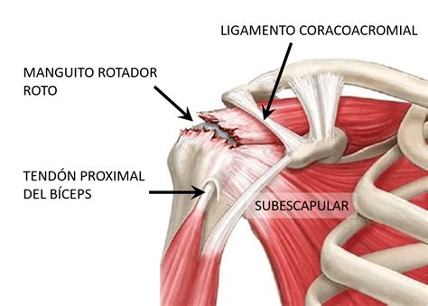 Gu A Completa Para Manejar El Dolor De Hombro En Atletas