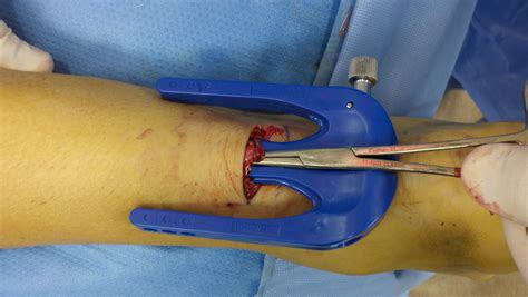 Achilles rupture repair - Advanced Foot And Ankle Center Of San Diego