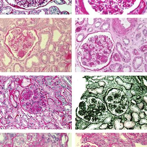 Differential Diagnosis Of Nodular Diabetic Glomerulosclerosis