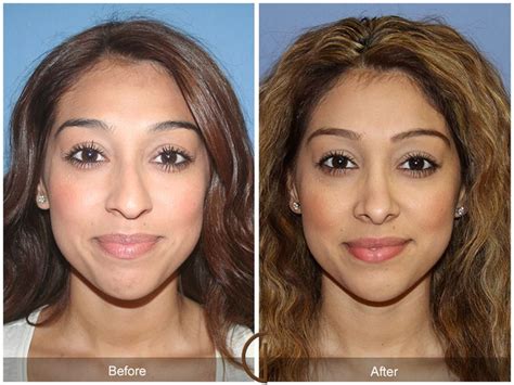 Rhinoplasty Nose Surgery Granite Hills Ca Before After Photo