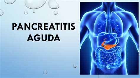 Pancreatitis Aguda Definici N Etiolog A Diagn Stico Y Tratamiento