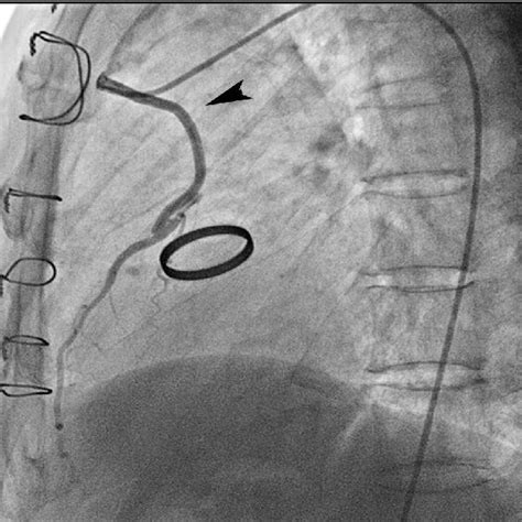 Coronary angiography showing patent saphenous vein graft (arrow)... | Download Scientific Diagram