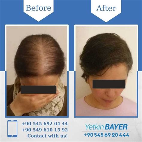 Fue Hair Transplant Women Before And After Picture Hair Transplant