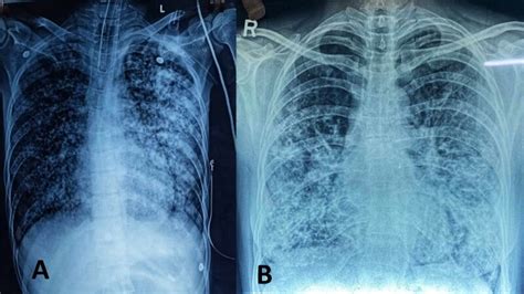 Figure 5 Chest Radiographs Suggesting Miliary Tb Endotext