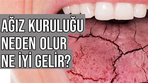 Ağız Kuruluğu Neden Olur Ne İyi Gelir