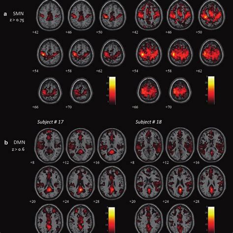 Functional Connectivity Maps For A Smn And B Dmn In Rapid Eye Download Scientific Diagram