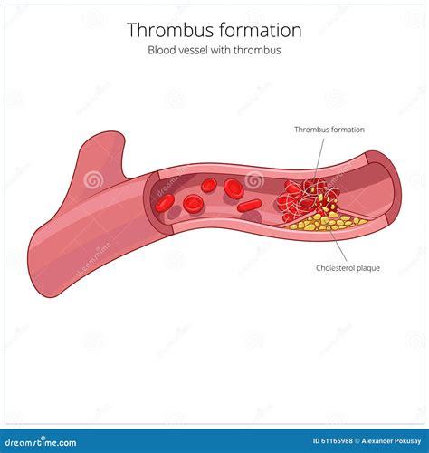 Blood Vessel And Clot Thrombus Vector Illustration Stock Vector - Image ...