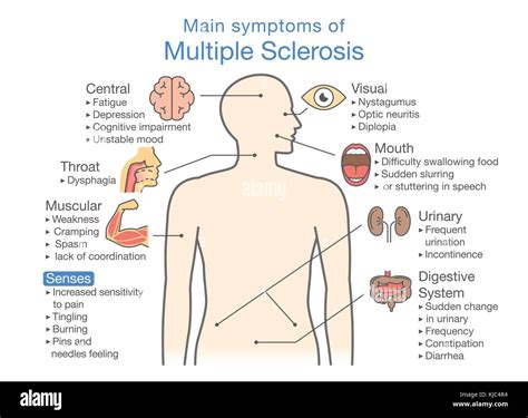 Main symptoms of multiple sclerosis Stock Vector Image & Art - Alamy