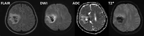 Temporal Pattern Of Cytotoxic Edema In The Perihematomal Region After