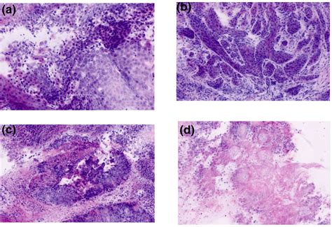 Features Of Oral Squamous Cell Carcinoma In Ex Vivo Fluorescence