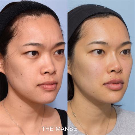 Asian Face Injectables And Laser Best Clinic Sydney For Dermal Fillers