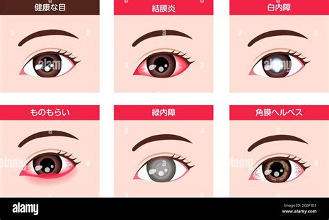 Varias Enfermedades Oculares Ilustraci N Vectorial Ojo Femenino