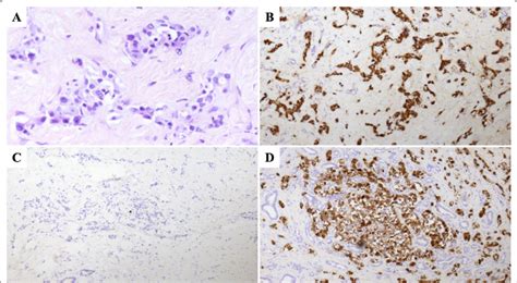 Histologic examination shows a neuroendocrine tumor G1 in the pancreas ...