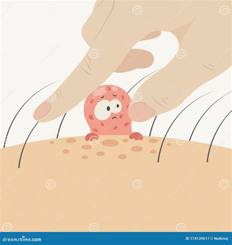 Popping Pimple To Icepick Scar Vector Illustration On White Background ...