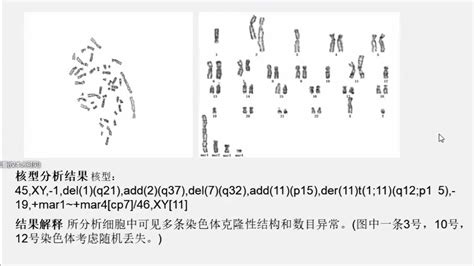 张美玲 骨髓染色体核型分析异常结果解读腾讯视频