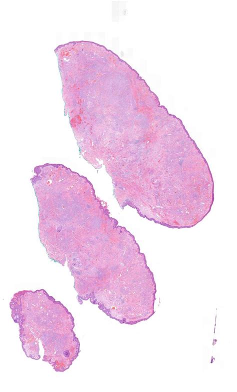 Polypoid Retiform Hemangioendothelioma With Persistence Kiko Xp