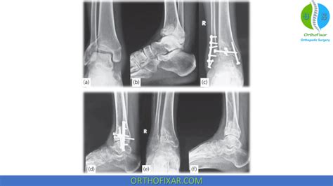 Pilon Fracture Tibial Plafond Fracture Orthofixar 2024