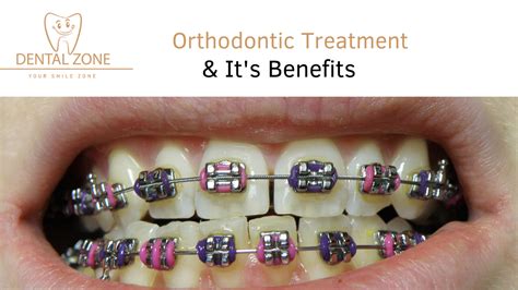 Orthodontic Treatment And Its Major Benefits What It Is Used For