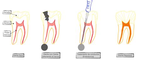 Endodoncia Y Corona Diferencias Y Beneficios Somos Dental 49 OFF