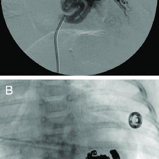 coil embolization  performed  minimize bleeding
