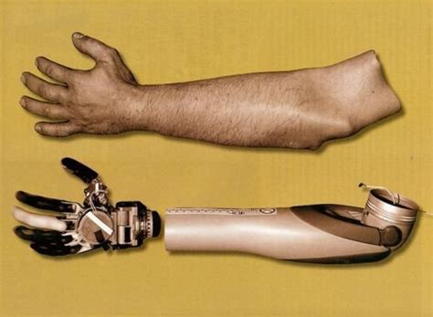 Prosthetic Arm Can Be Controlled Naturally Provide Sensory Feedback Prosthetics Arms Johns