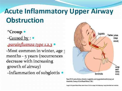 Croup Could Be Caused By All Of