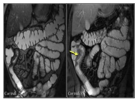 Inflammatory Bowel Disease Imagingradiology