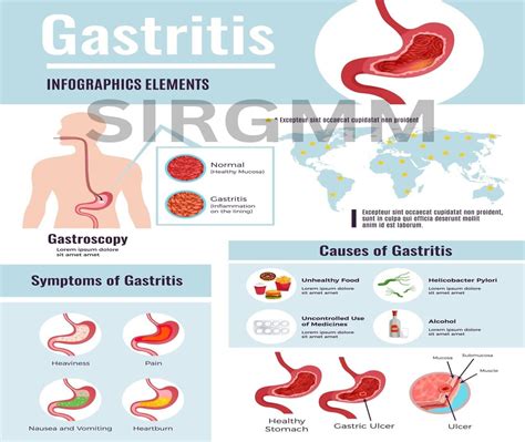 What Causes Gastroenteritis? – SIRGMM