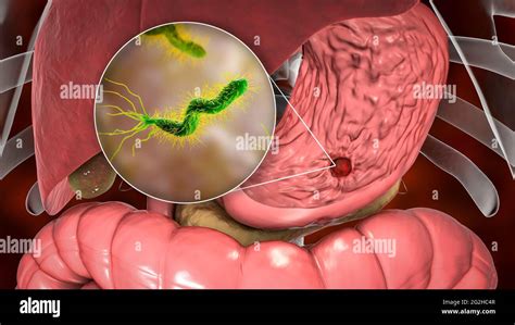 Úlcera gástrica y bacteria Helicobacter pylori ilustración Fotografía