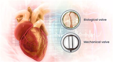 Mechanical Vs Biological Valve