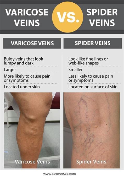 Home Remedies For Spider Veins Artofit