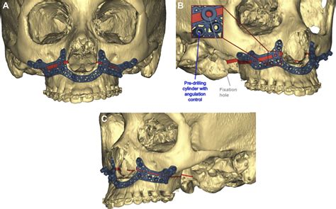 Three Dimensional Repositioning Of The Maxilla In Orthognathic Surgery