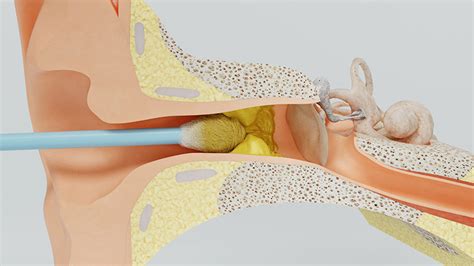 Ear Medical & Surgical Conditions in Castle Rock, CO