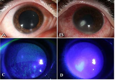 Slit Lamp Examination And Fluorescein Staining In The 3rd Day A Two