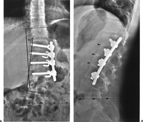 Spinal Instrumentation Radiology Key