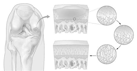 Optimal Cartilage Repair In The Knee One Step Closer Through Second