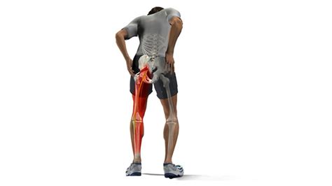 What Is Piriformis Syndrome Entirely Health