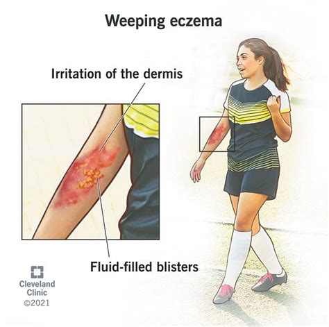 Eczema causes – Artofit